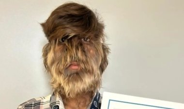 'बाल हनुमान' का रूप मानते थे लोग, डर जाते थे बच्चे. गिनीज बुक में दर्ज हुआ अजीब बीमारी से ग्रस्त MP के ललित का नाम